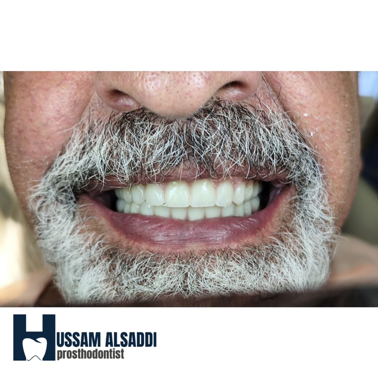 Smile restoration result after dental treatment