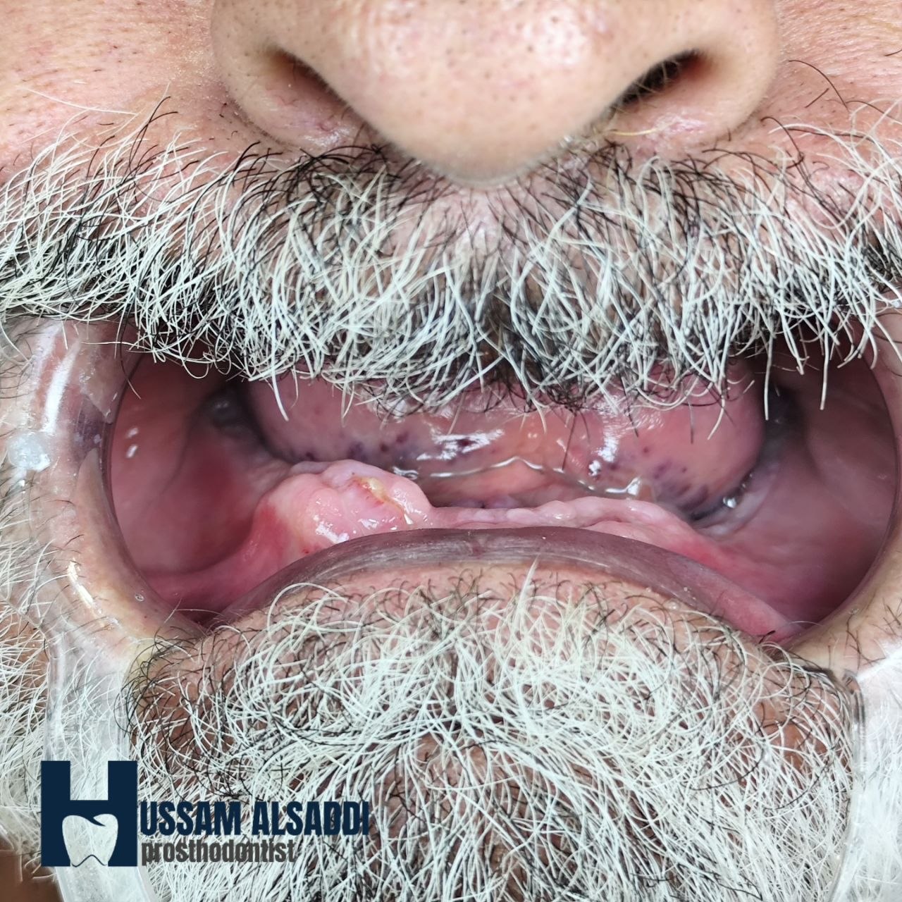 Clinical view before smile restoration treatment