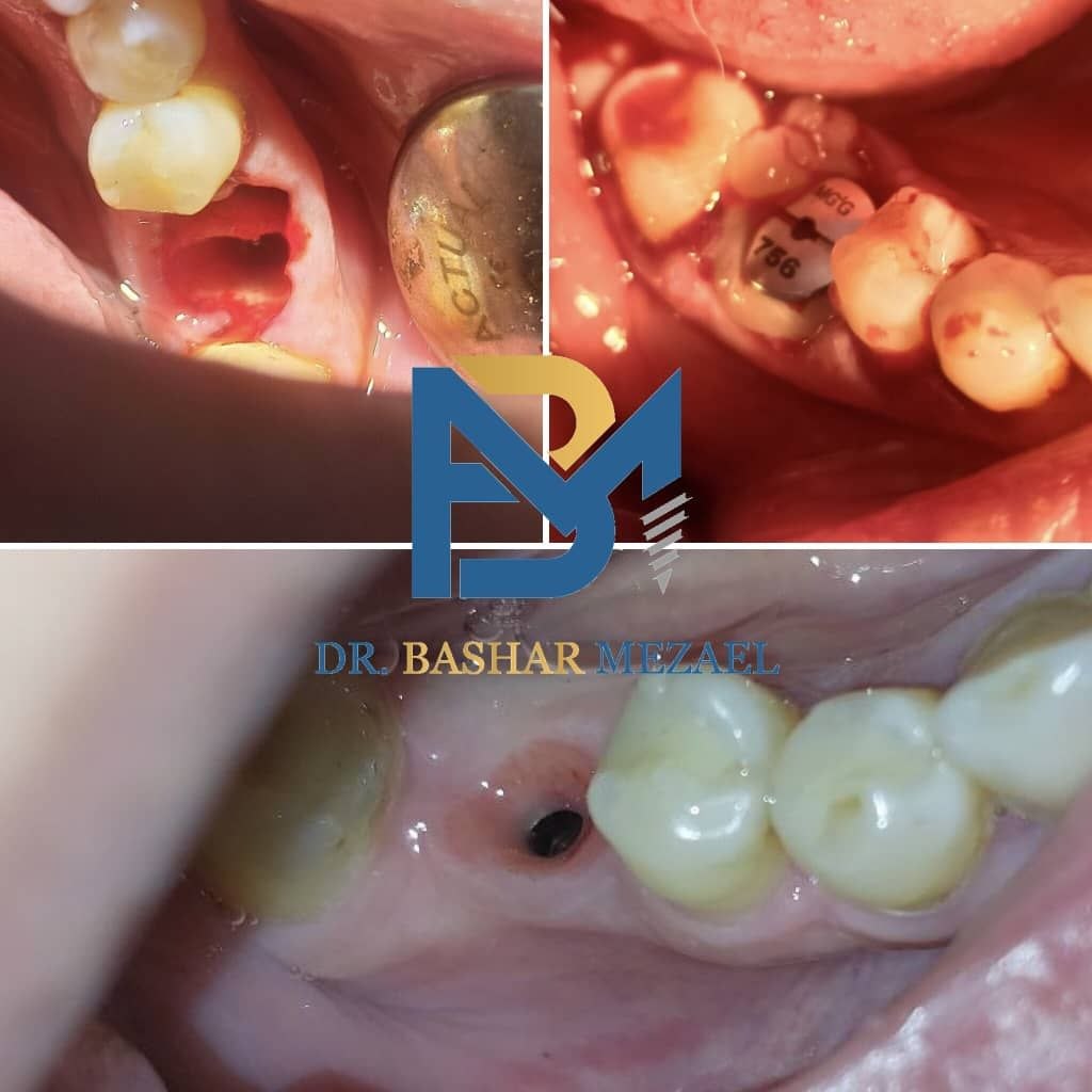 Clinical implant-related case collage by Dr. Bashar Mezael