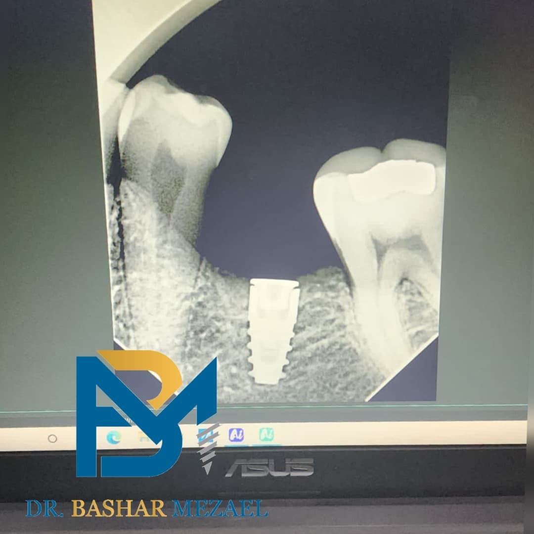 Radiographic implant view from a clinical case by Dr. Bashar Mezael