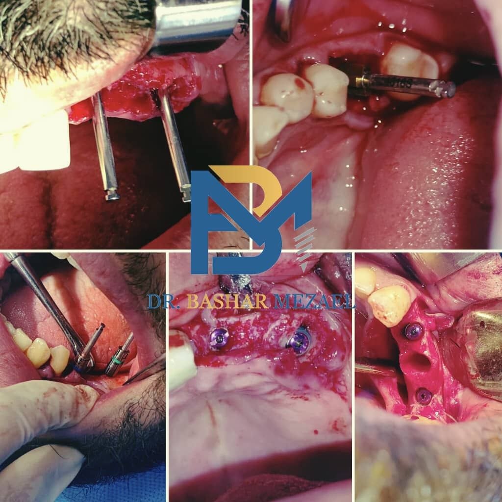 Surgical procedure collage from a case by Dr. Bashar Mezael