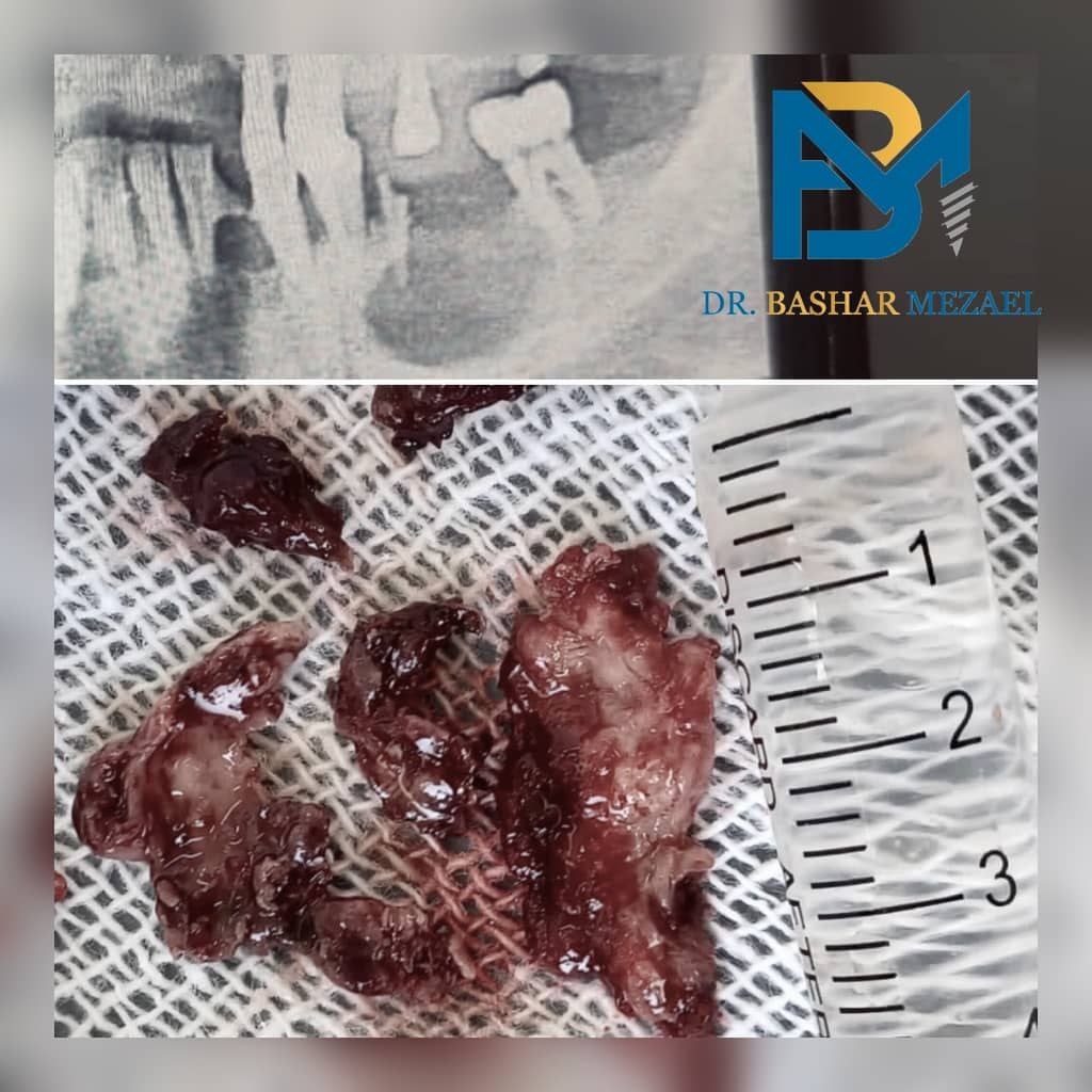 Clinical and radiographic surgery case collage by Dr. Bashar Mezael