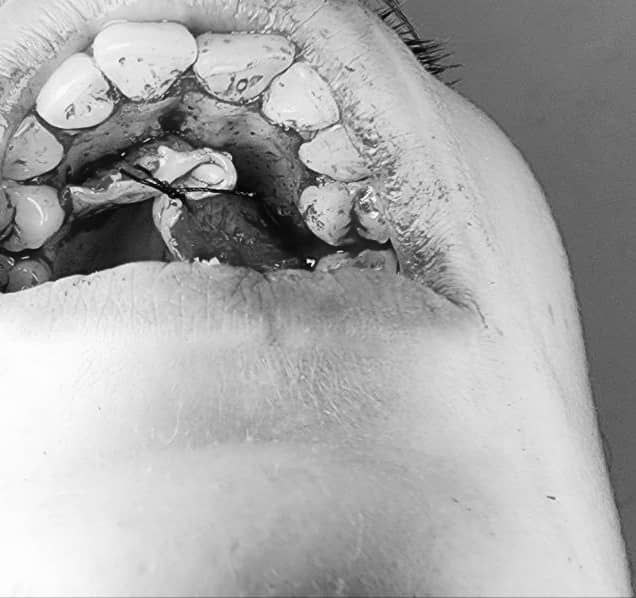 Clinical oral surgery image from a case by Dr. Bashar Mezael